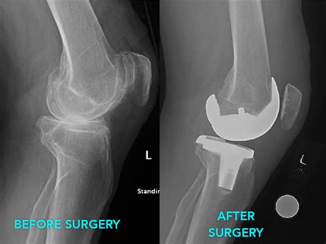 joint replacement near hercules|Joint Replacement Surgery .